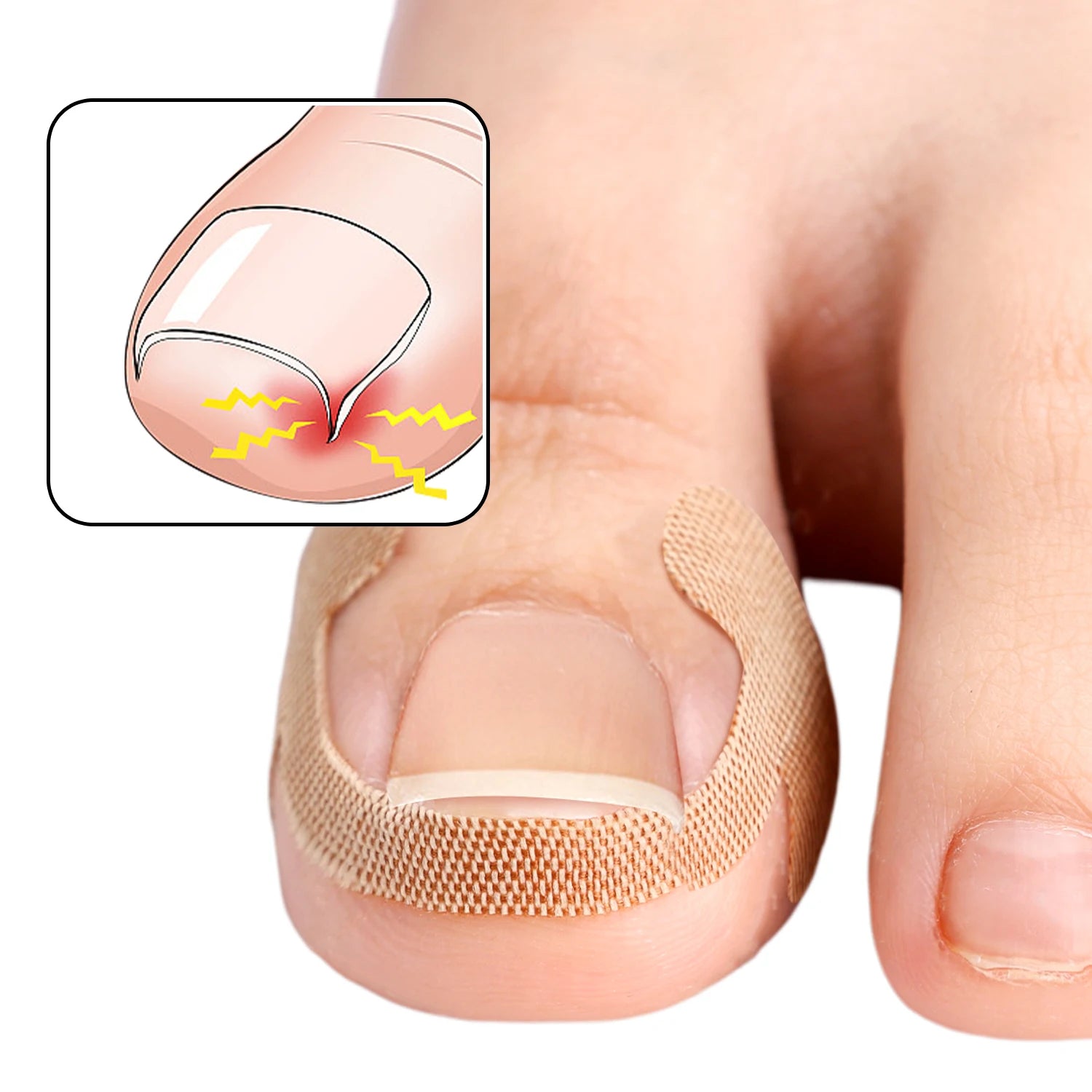 #1 Toenail Correction Strips