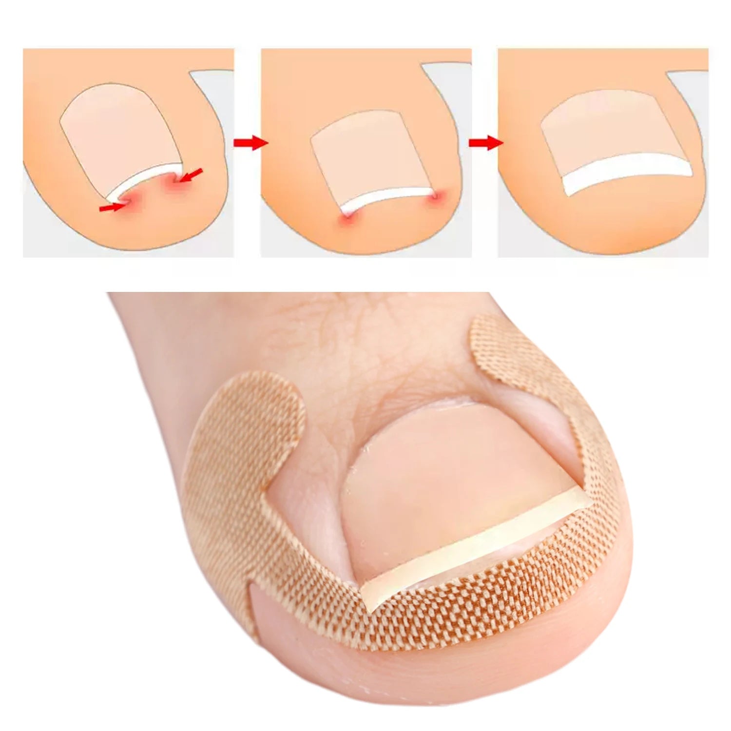 #1 Toenail Correction Strips