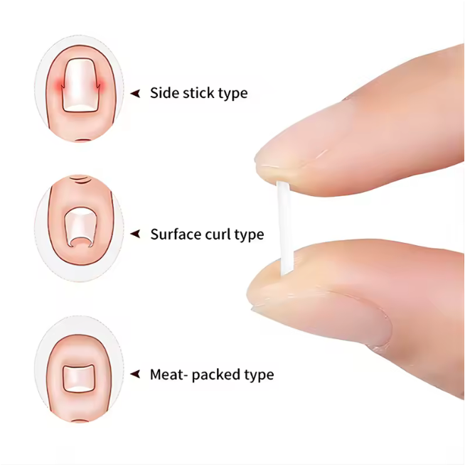 #1 Toenail Correction Strips