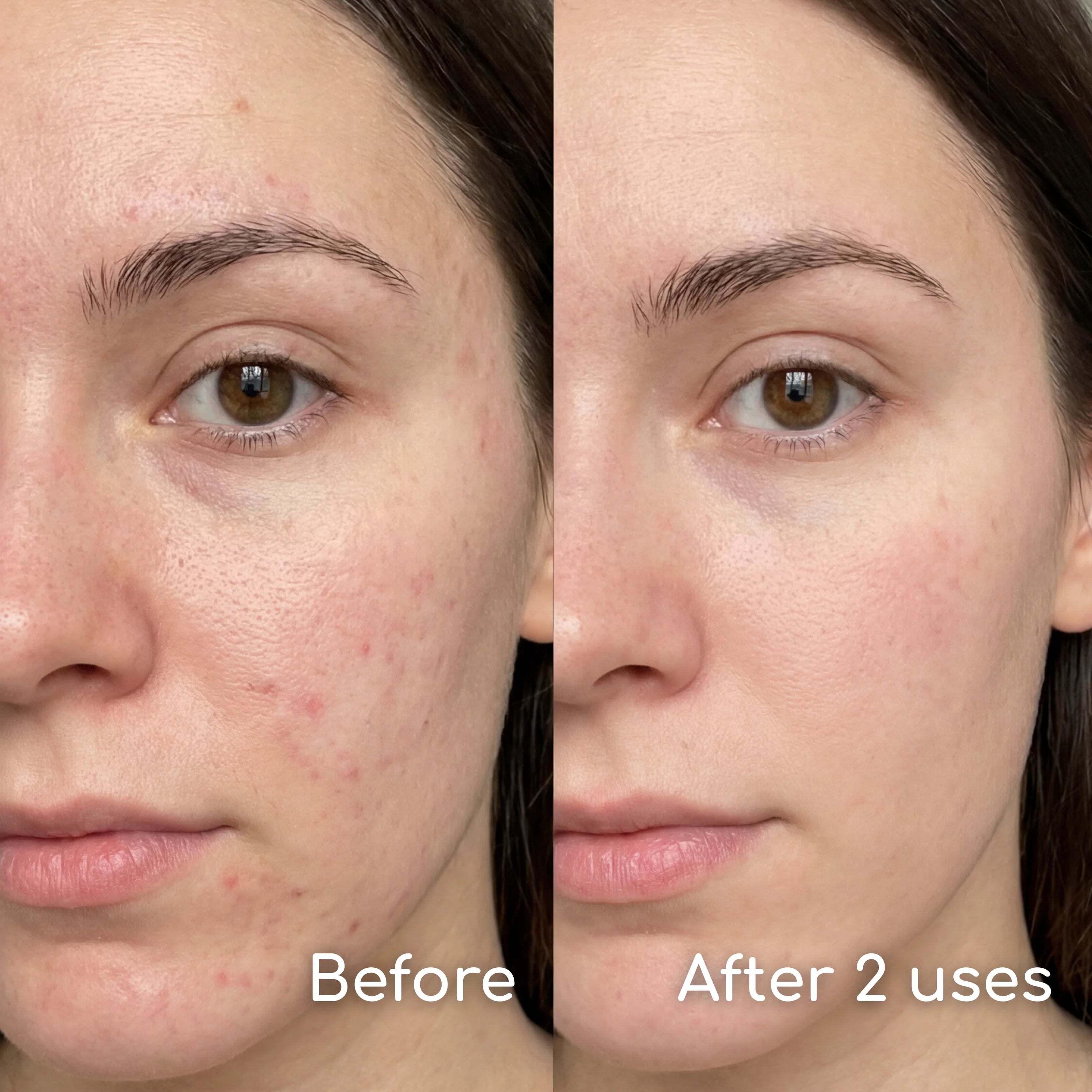 Pimple Patch Mask