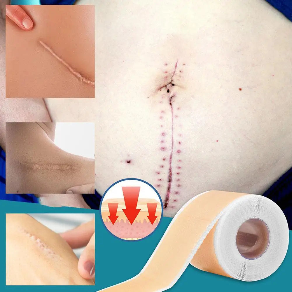 Silicone Scar Sheets