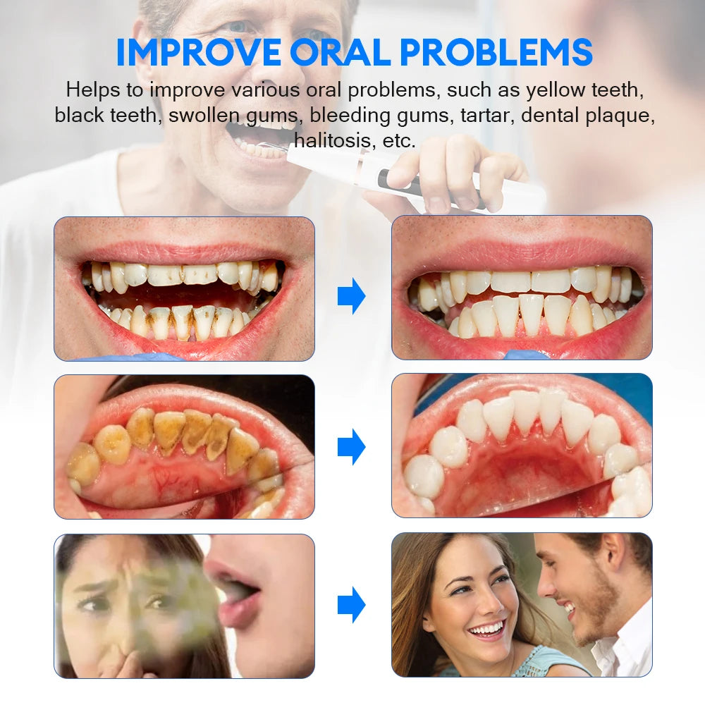 #1 Electric Teeth Cleaner